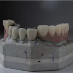 Bite Back Better: How Modern Dental Implants Are Redefining Smiles