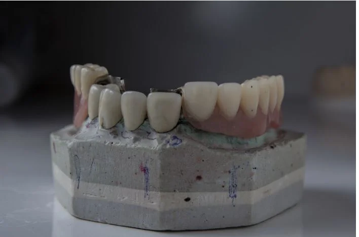 Bite Back Better: How Modern Dental Implants Are Redefining Smiles