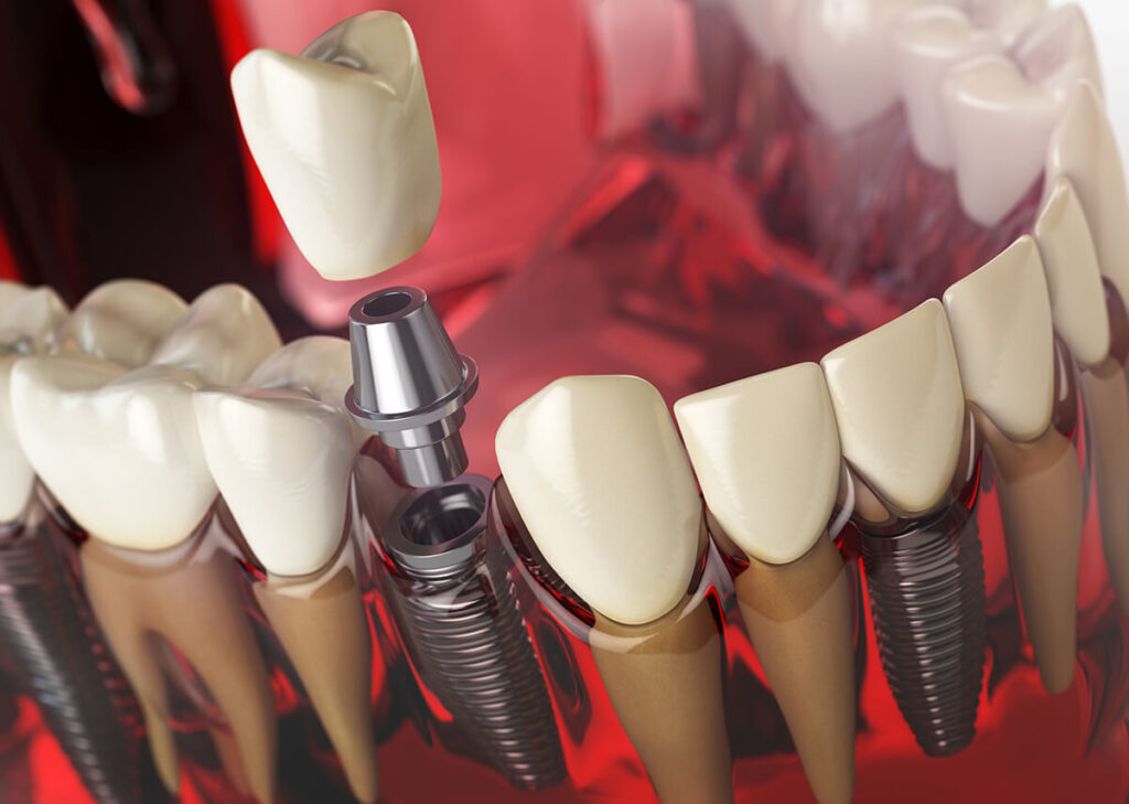 Dental Implants: Cost, Procedure & Types