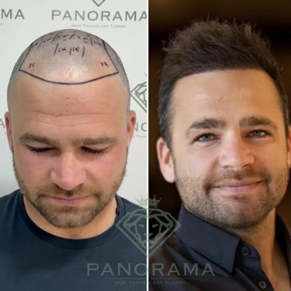 Revitalize Your Hair with Panorama Hair Turkey’s Exceptional Quality