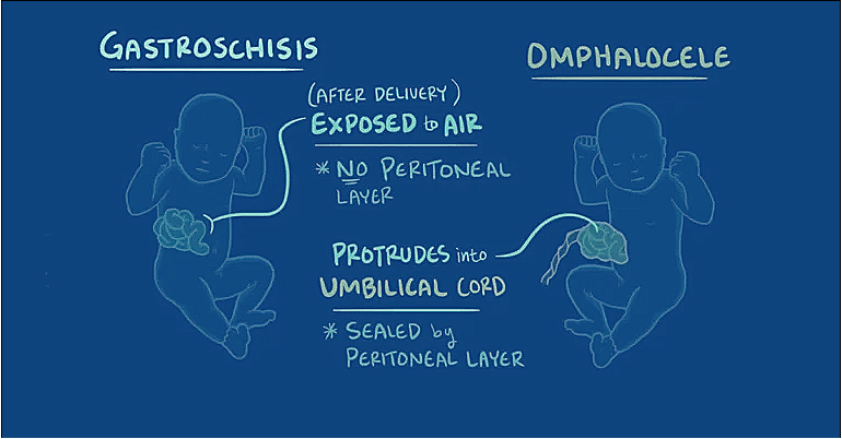 Gastroshiza: Causes, Symptoms, Diagnosis, and Treatment