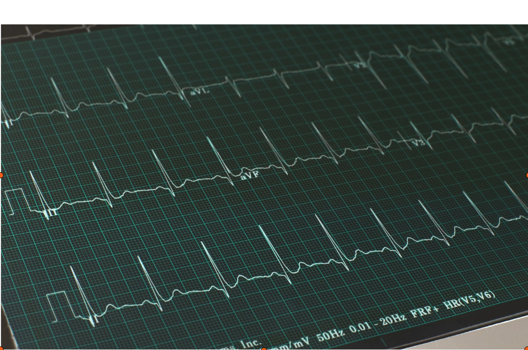 What Is Borderline ECG – Complete Explanation, Causes, and Clinical Significance