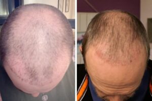 http://Is%20a%20Hair%20Transplant%20Worth%20It?%20Facts,%20Process,%20and%20Results