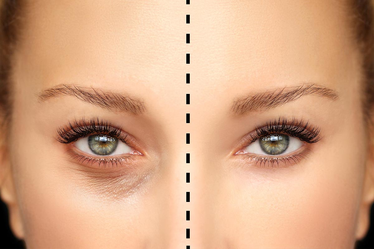 After Blepharoplasty: Recovery Timeline and Care Tips
