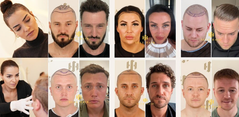 Top 10 Hair Transplant Clinics in Turkey (2026 Edition)